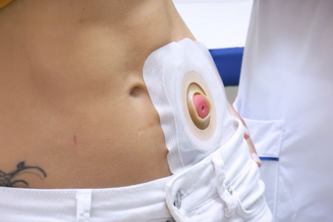 Colostomía Dr Xavier Obando Coloproctólogo Quito